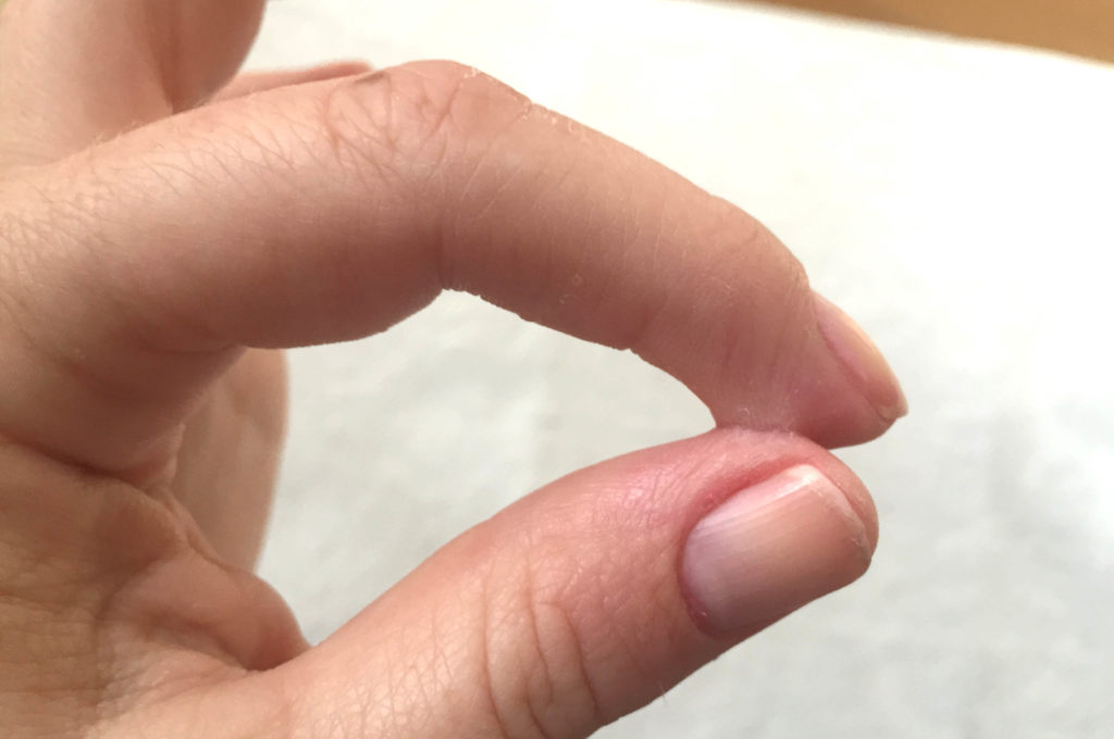 how to get superglue off of skin